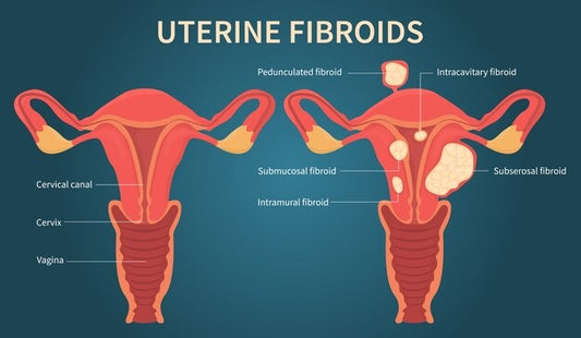 Quels sont les différents fibromes utérins ?